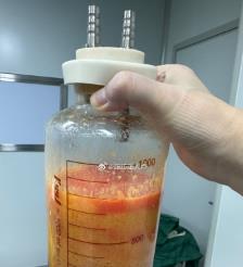 玉林水动力吸脂手术要做多久？